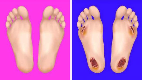 Dấu hiệu bệnh tật thông qua thay đổi của bàn chân